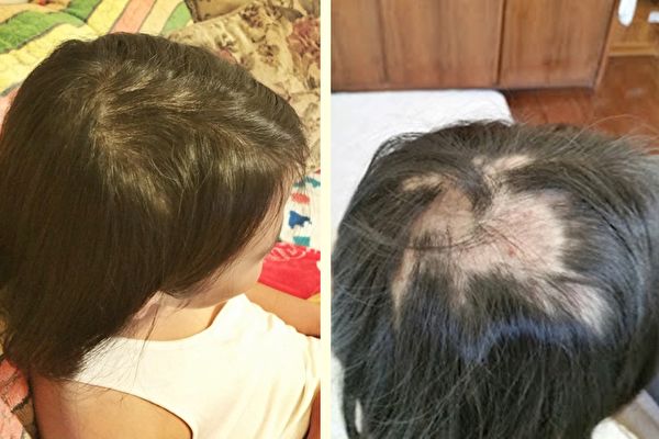 10岁女孩的秃头神奇痊愈 母女因祸得福